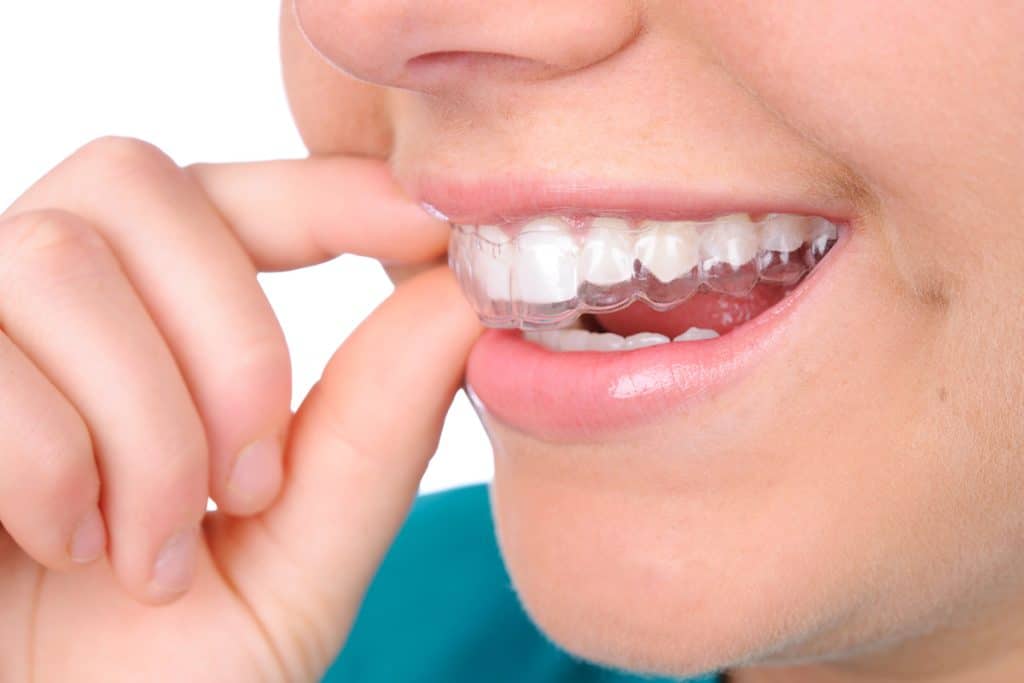 Underbite Treatment with Invisalign: What to Expect